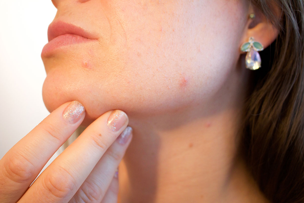 Woman examining healing scar on face